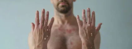 Tipo raro de mpox é identificado em três homens gays nos Estados Unidos