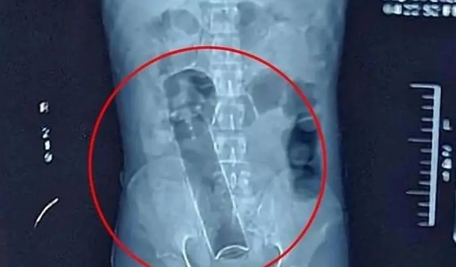 Empresário busca atendimento após desodorante ficar preso no ânus em Rondônia