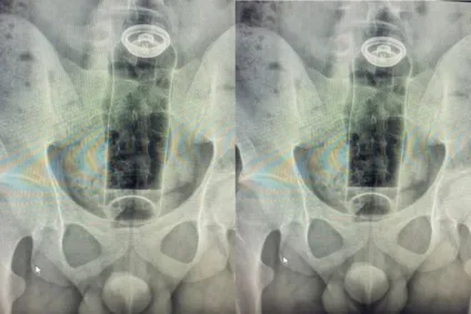 Jovem de 19 anos é internado após objeto ficar preso no ânus