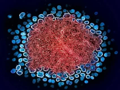 Homem tem remissão do HIV após transplante de medula de irmão