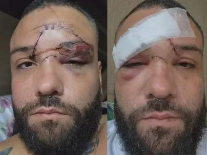 Designer sofre 35 pontos no rosto após sofrer ataque homofóbico em bar no Rio